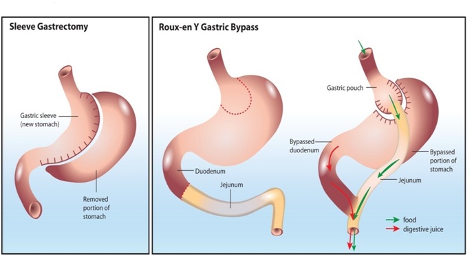What To Choose Between Gastric Sleeve And Gastric Bypass