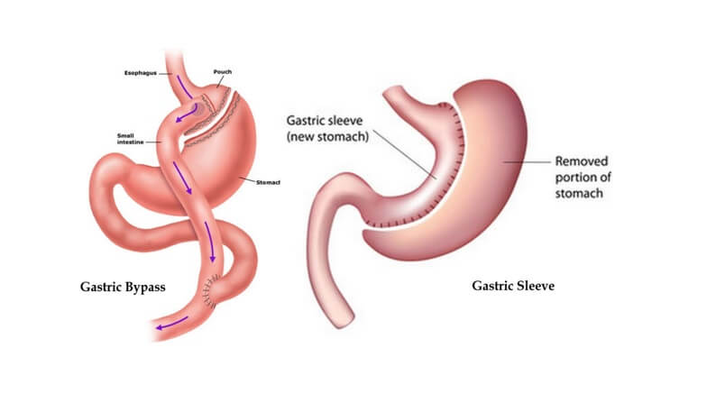 How Is Gastric Sleeve Different Than Gastric Bypass