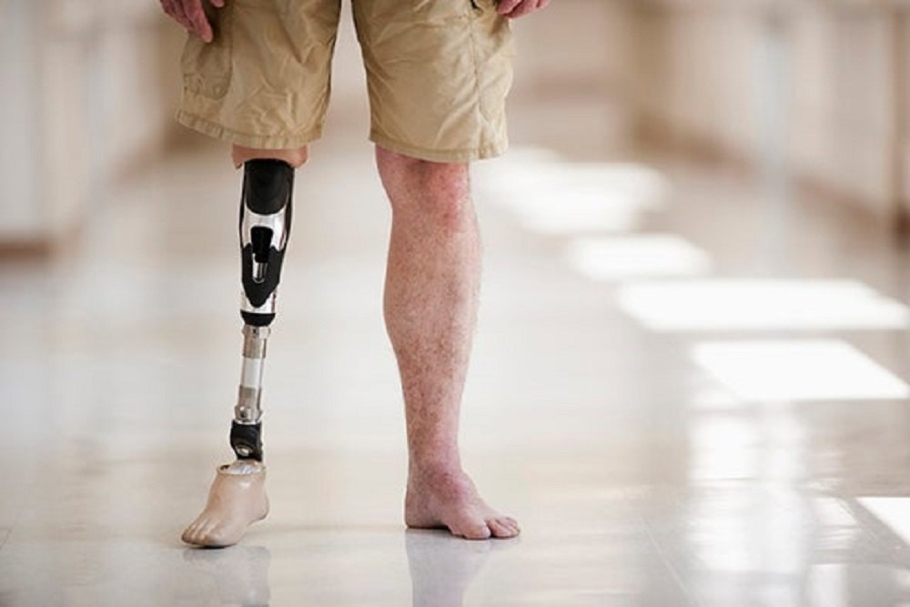 Advanced Prosthetic Knees: Innovations In Above-knee Prosthetics - Self 