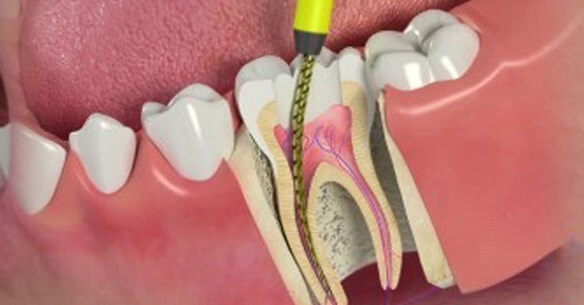 What to Do If a Root Canal Doesn't Work?